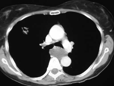 congenital lung disease